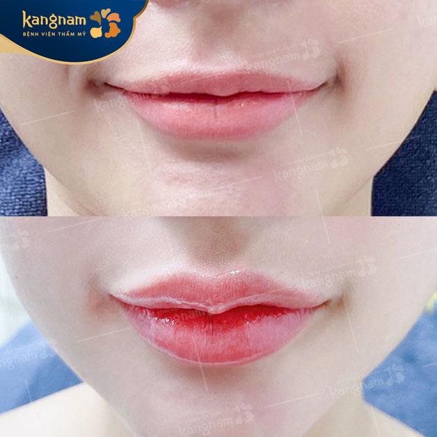 Môi lành ổn định, không sẹo