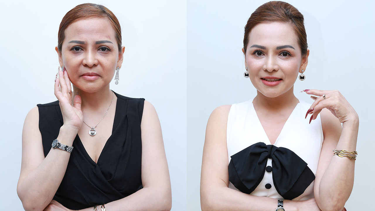 ảnh trước và sau của khách hàng sau khi căng da mặt bằng chỉ