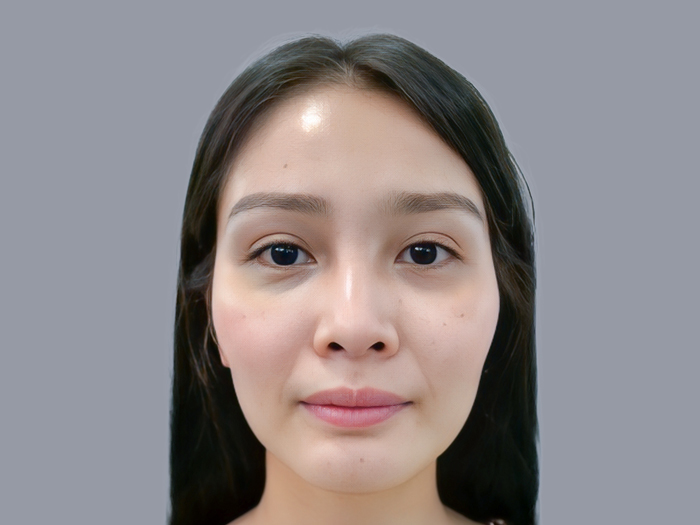 mặt hóp, thiếu thể tích nên cân nhắc cấy mỡ