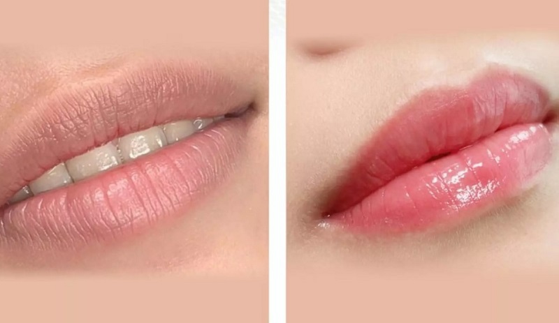 Dùng nước muối sinh lý để vệ sinh môi sạch sẽ
