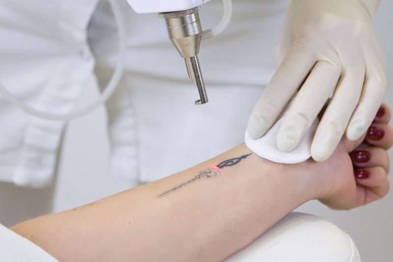 Laser Picosure hoặc Picosure Pro
