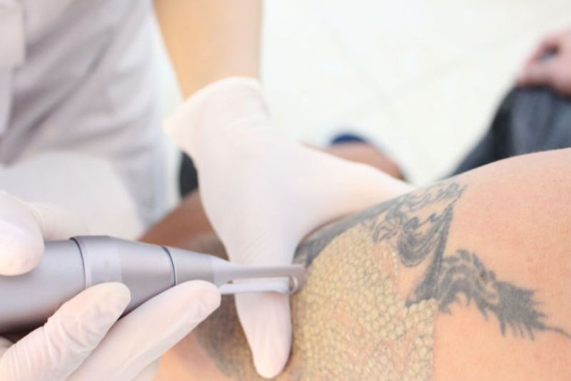Cơ thể có khả năng đào thải mực xăm khác nhau ở mỗi người