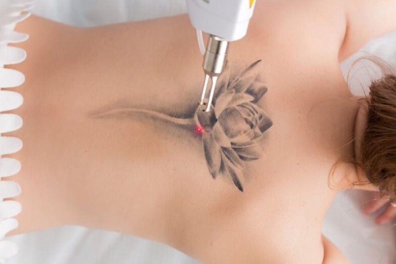 Xóa hình xăm bằng laser mỗi lần cách nhau 6-8 tuần