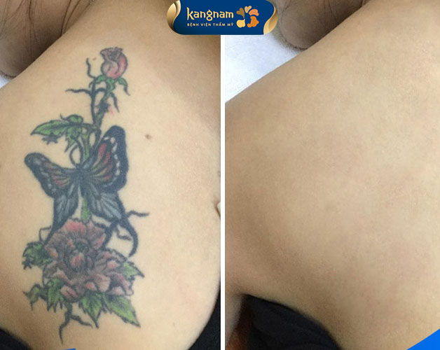 Kết quả thực tế sau quá trình điều trị bằng công nghệ laser hiện đại
