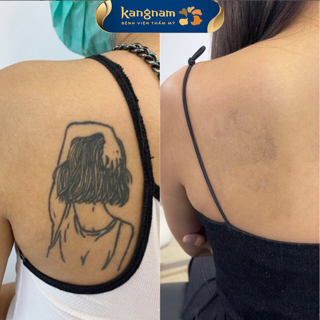Tia laser tác động trực tiếp vào các phân tử mực dưới da, làm chúng phân rã thành các mảnh cực nhỏ