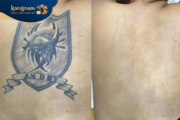 Tia laser có thể loại bỏ gần như hoàn toàn hình xăm