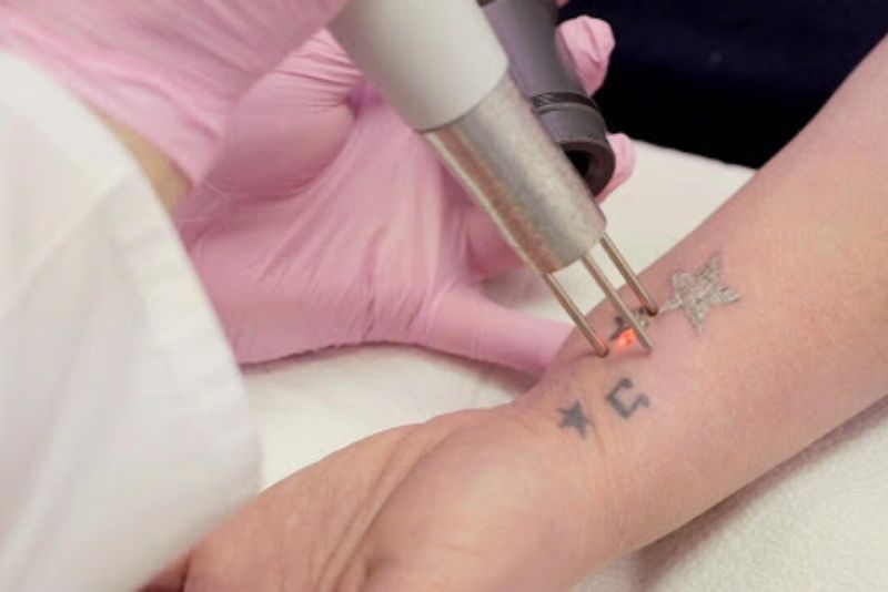 xóa xăm bằng laser được đánh giá là phương pháp hiệu quả và an toàn nhất