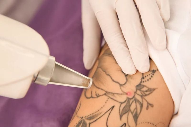 Công nghệ này sử dụng tia laser năng lượng cao để phá vỡ các hạt mực xăm thành những mảnh cực nhỏ