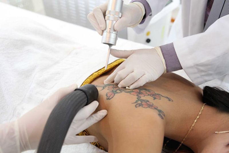 Xóa xăm thực hiện đúng kỹ thuật thì rất hiếm khi để lại dấu vết hoặc sẹo