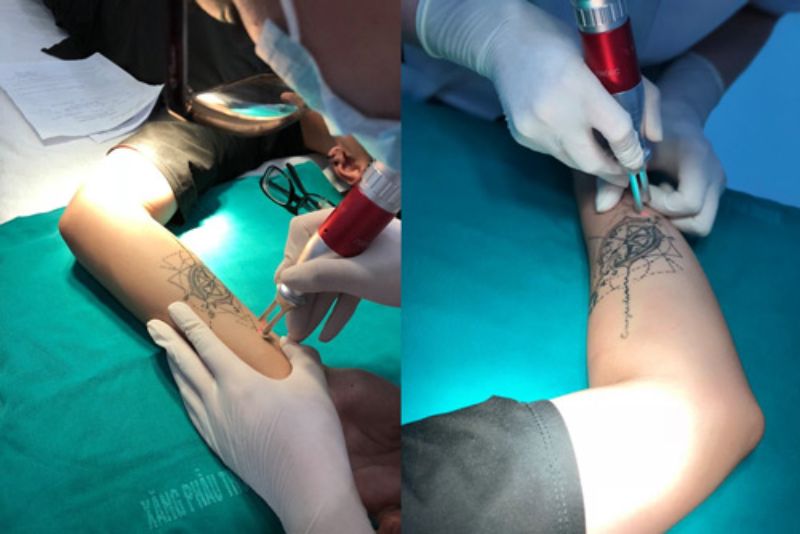 Xóa hình xăm tại Bệnh viện 108 ứng dụng công nghệ Laser Pico Plus