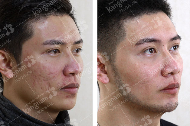 Hết sẹo mụn sau 1 liệu trình