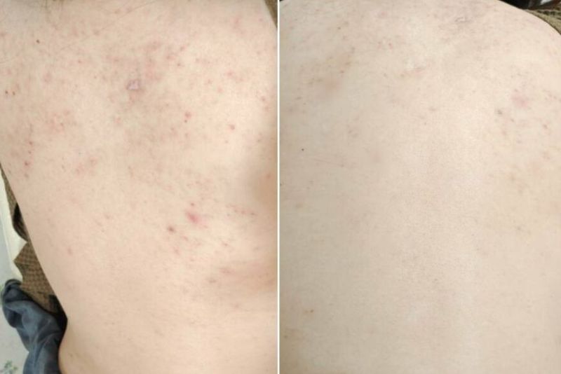 Bắn laser trị thâm mụn lưng là phương pháp hiệu quả