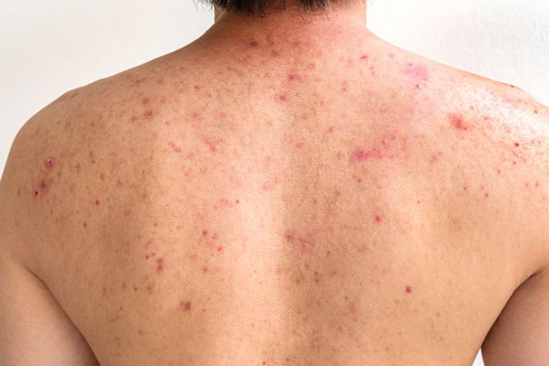 Người bị thâm do mụn lưng lâu năm