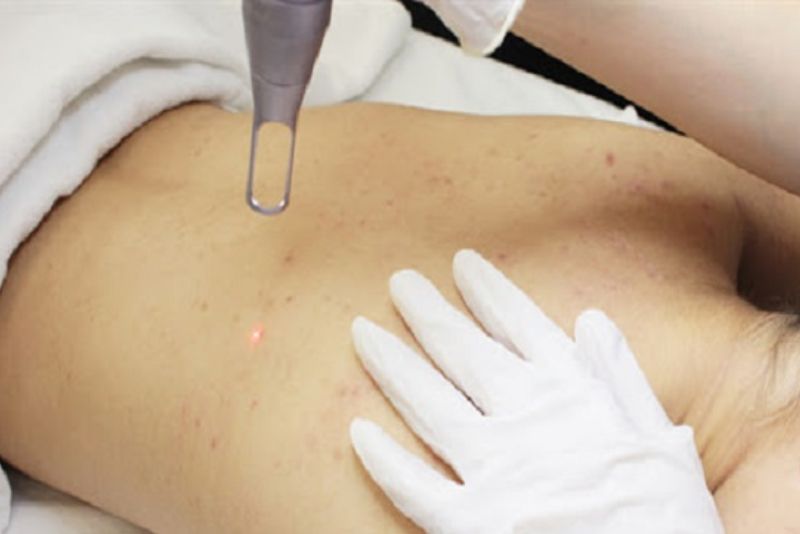 Laser trị thâm mụn lưng