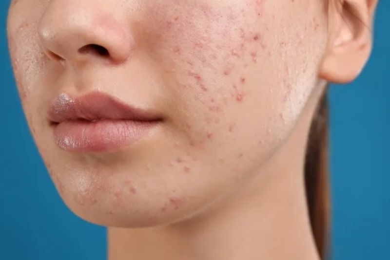 Nguyên liệu tự nhiên không thể xóa sổ thâm mụn lâu năm