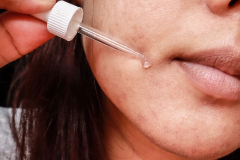 Giảm thâm mụn bằng serum chứa vitamin C và E