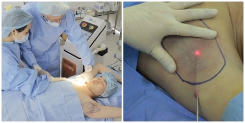 Cắt tuyến mồ hôi nách nội soi loại bỏ tuyến mồ hôi nách triệt để