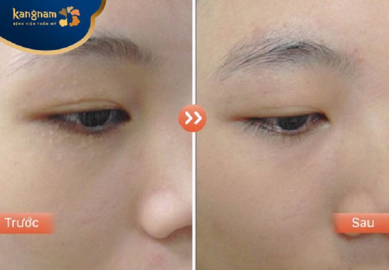 Laser CO2 Fractional mang lại kết quả tối ưu