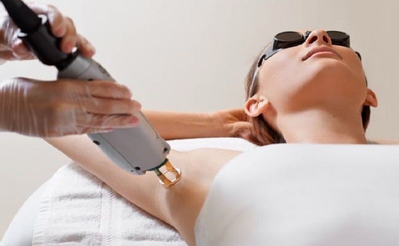 Laser dùng bước sóng phù hợp để ngăn chặn tuyến mồ hôi hoạt động