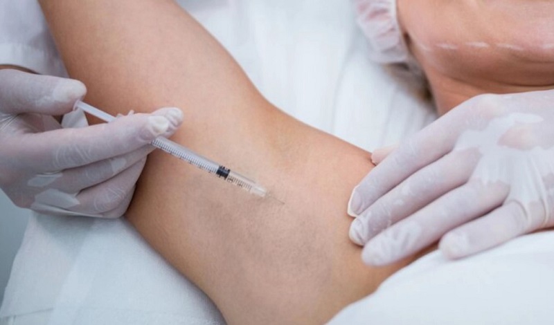 Tiêm botox giúp giảm thiểu hoạt động của tuyến mồ hôi