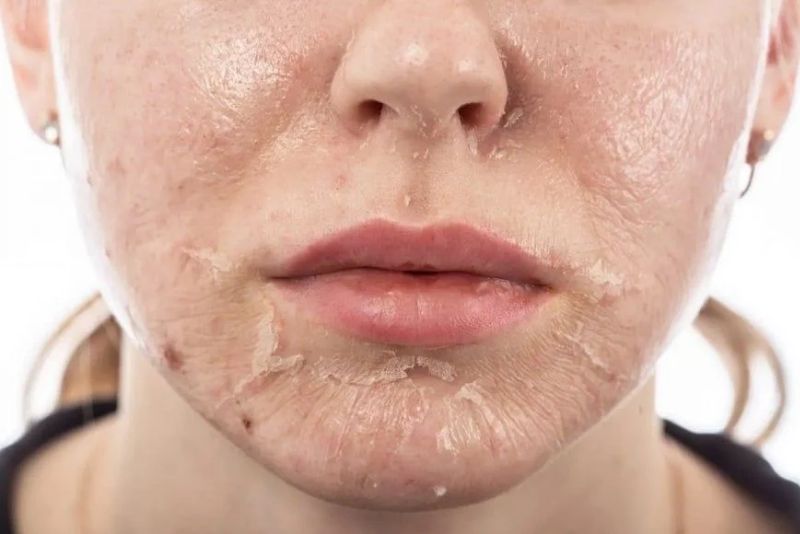 Peel da hóa học sử dụng axit nồng độ cao giúp loại bỏ lớp tế bào sừng già cỗi và melanin tích tụ gây thâm
