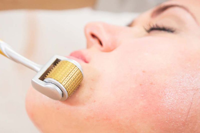 Lăn kim trị mụn cần từ 5-7 ngày để da ổn định lại