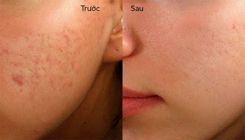 Làn da mịn màng, săn chắc hơn sau điều trị