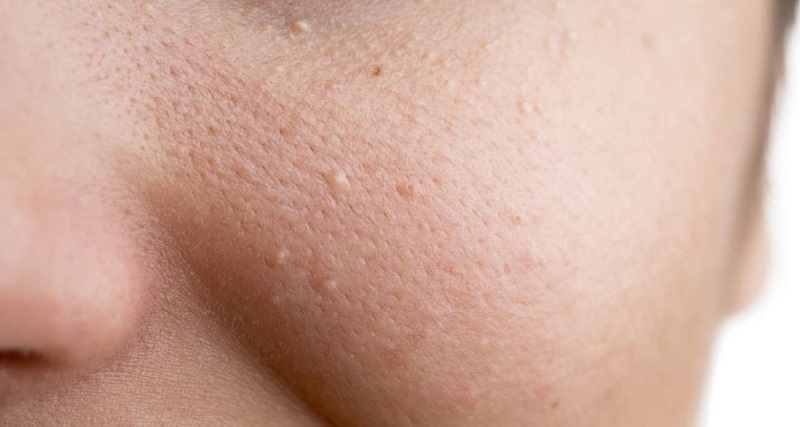 Những nốt mụn thịt sần sủi, li ti trên bề mặt da