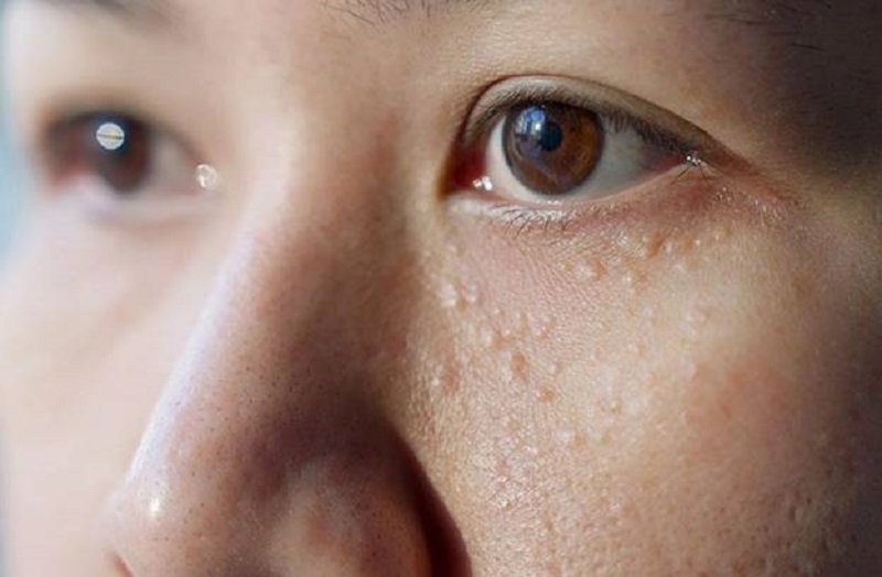 Các nốt mụn thịt không thể tự hết được