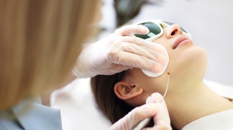 Đốt mụn thịt sau vài tuần sẽ hết hoàn toàn