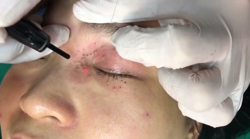 Phương pháp đốt mụn thịt được sử dụng mang lại hiệu quả cao