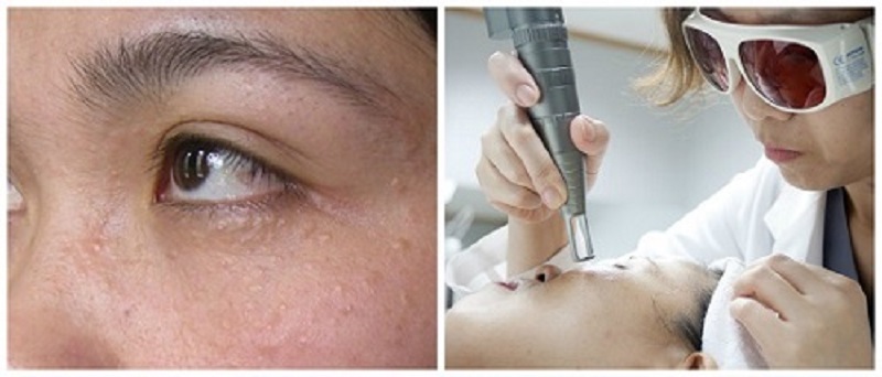 Tia laser với bước sóng phù hợp để điều trị mụn thịt