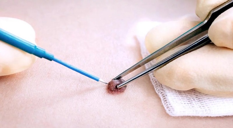 Đốt điện cũng mang lại hiệu quả trị mụn thịt cao