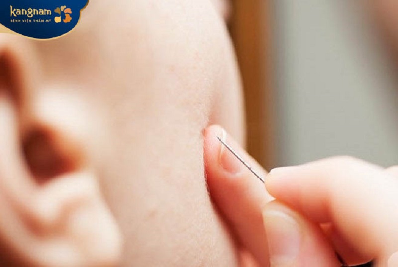 Không được tự ý nặn mụn thịt tại nhà