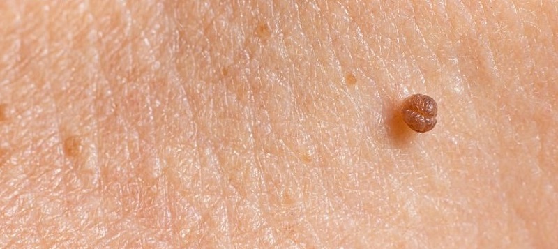 Mụn thịt dư có thể không nguy hiểm nhưng sẽ lây lan sang các vùng da xung quanh