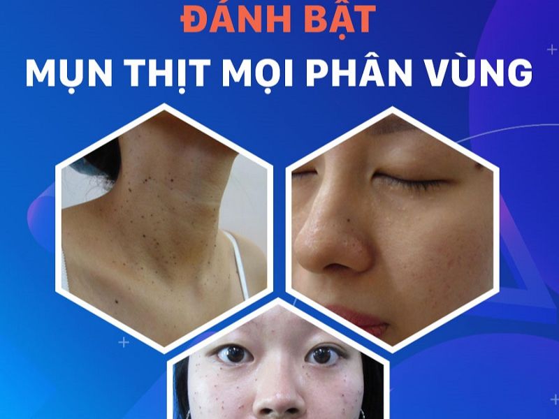 Kangnam ứng dụng laser CO2 để trị mụn thịt
