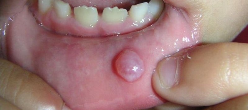 Mụn thịt ở miệng mọc thành từng nốt riêng lẻ hoặc theo cụm