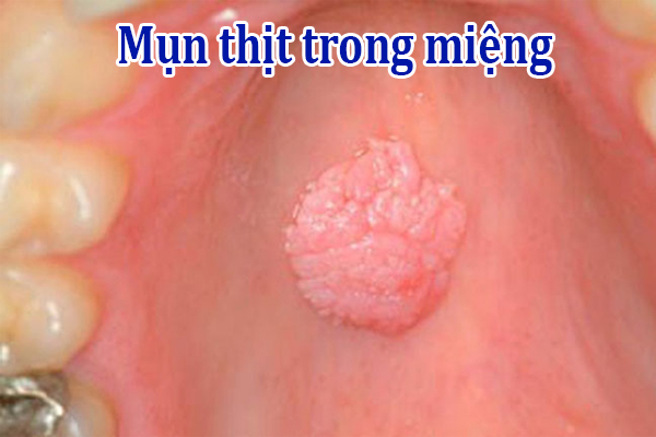 Các nốt mụn thịt có thể gây đau hoặc không