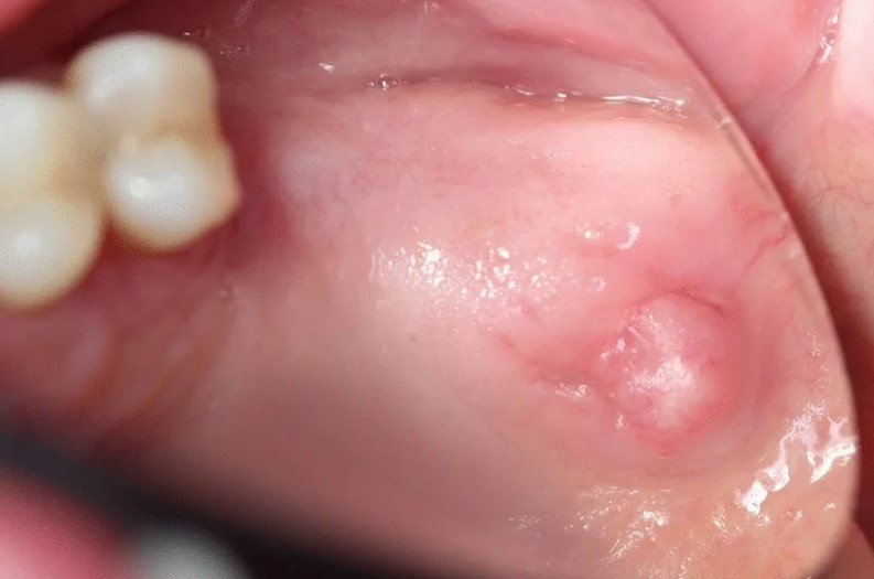 Nguyên nhân gây mụn thịt do sưng nướu hoặc tắc tuyến nước bọt