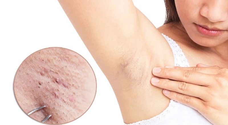 Mụn thịt ở nách gây khó chịu và ảnh hưởng đến tính thẩm mỹ