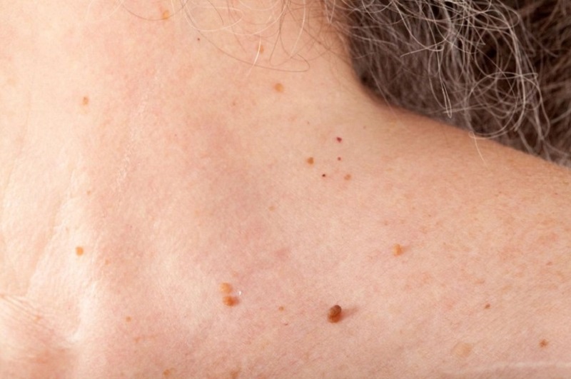 Các nốt mụn thịt li ti mọc xung quanh cổ