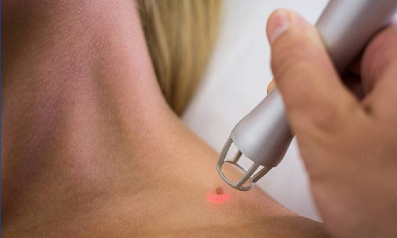Sử dụng laser cũng là cách được bác sĩ áp dụng