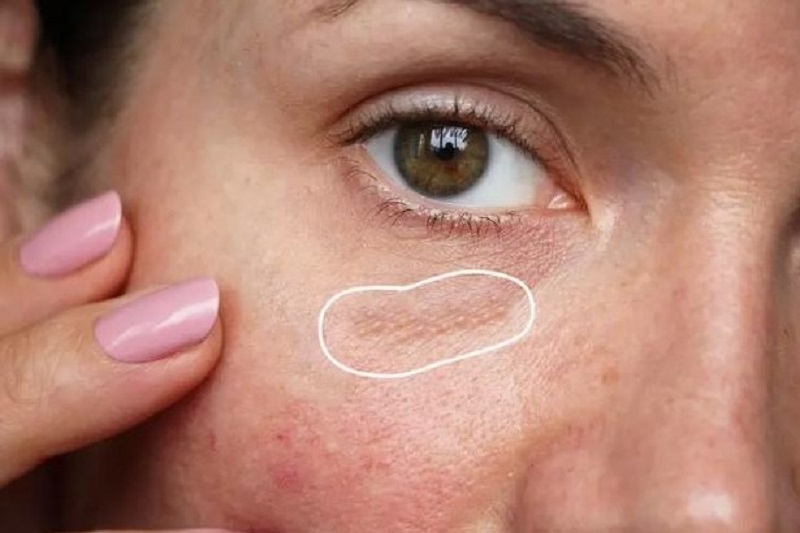 Mụn thịt trên mặt có thể phát triển và lây lan ra xung quanh