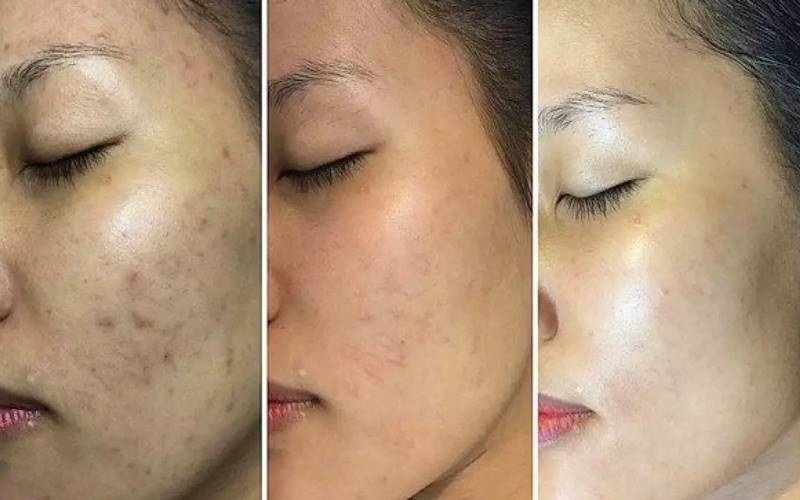 Làn da có sự thay đổi rõ rệt sau vài liệu trình