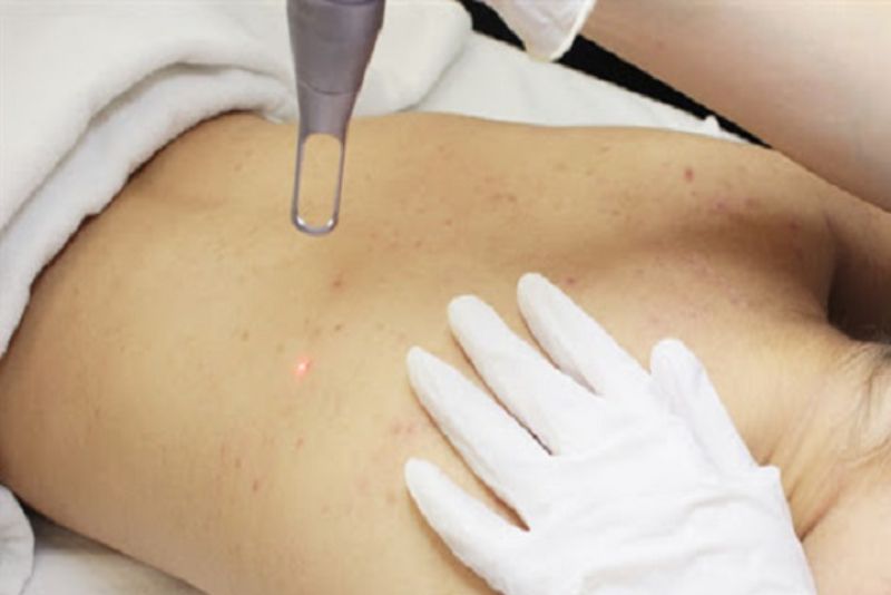 Bắn laser