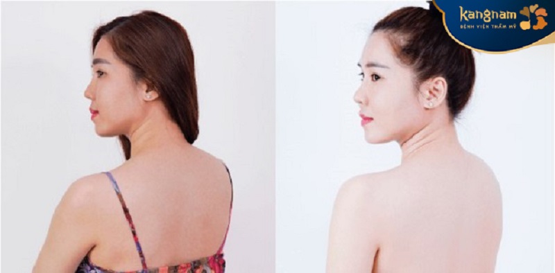 Làn da trắng sáng bật tone sau 1 liệu trình