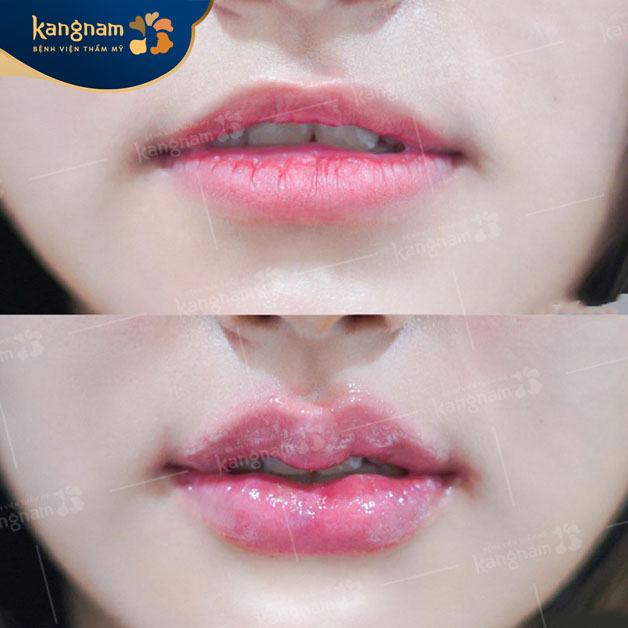 Môi tim xinh, cân đối với gương mặt