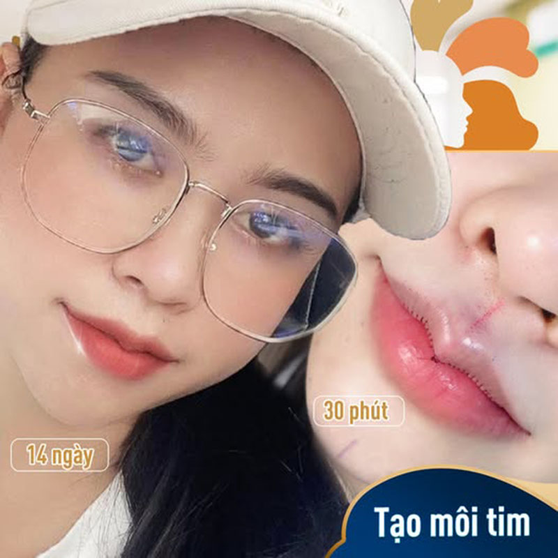 Phẫu thuật tạo hình môi giúp định hình dáng môi trái tim lâu dài