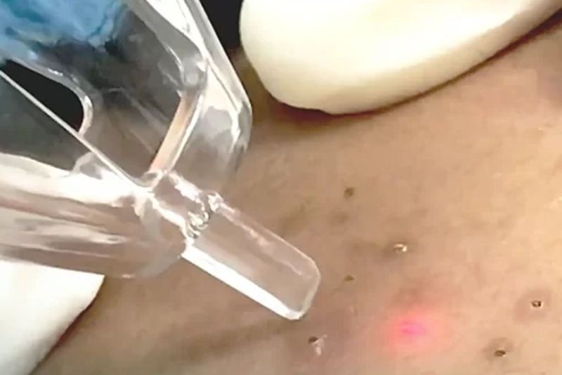 Laser trị thâm mụn