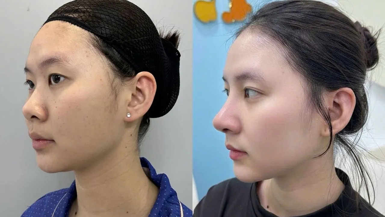 Thanh Thảo thay đổi sau nâng mũi, dáng mũi tự nhiên giúp gương mặt có thêm điểm nhấn